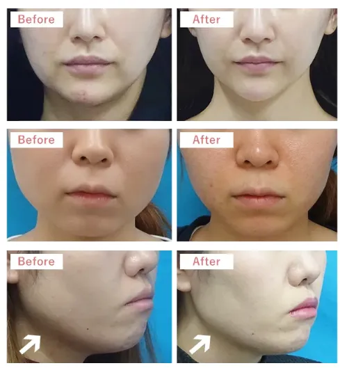 脂肪溶解注射の症例