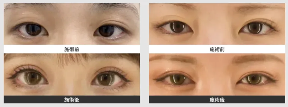 HAABクリニックの二重整形の症例写真