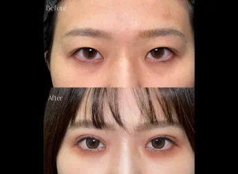 岩井勝矢医師の二重埋没法の症例