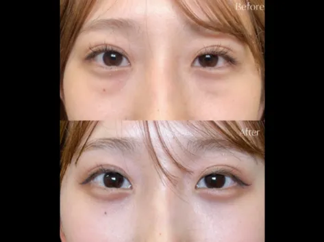 岩井勝矢医師のクマ治療の症例