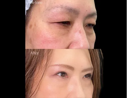 岩井勝矢医師の上眼瞼治療の症例