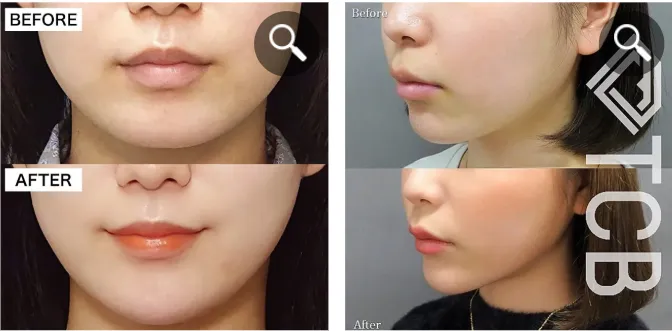 TCBのエラボト症例