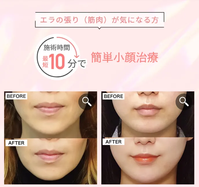 TCBのエラボト症例