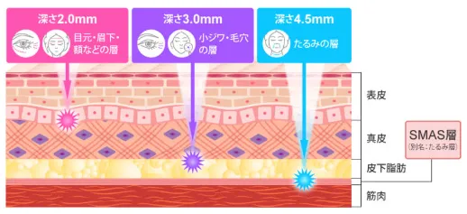 TCBのハイフ種類