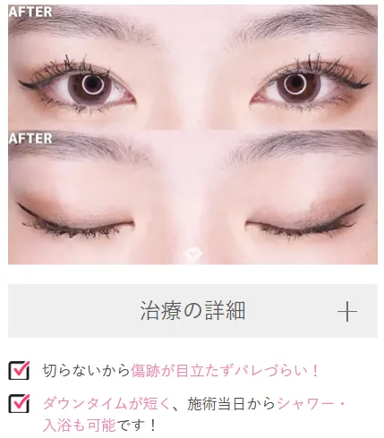 広島二重整形おすすめ
施術後画像