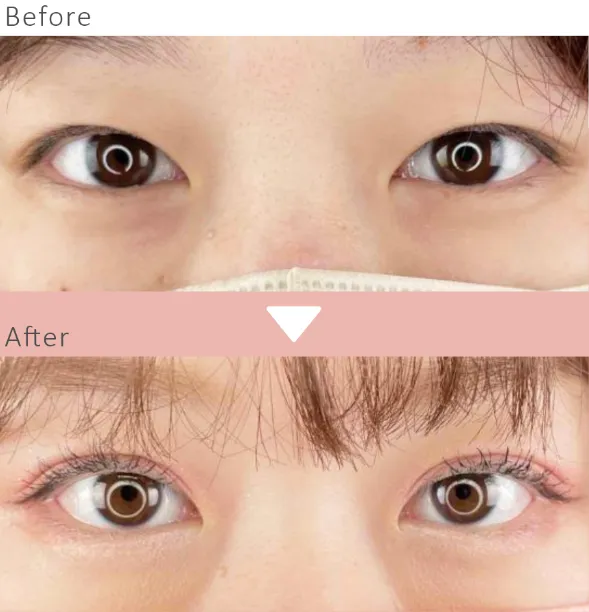 ルラ式の独自の二重整形は15分で施術が完了する