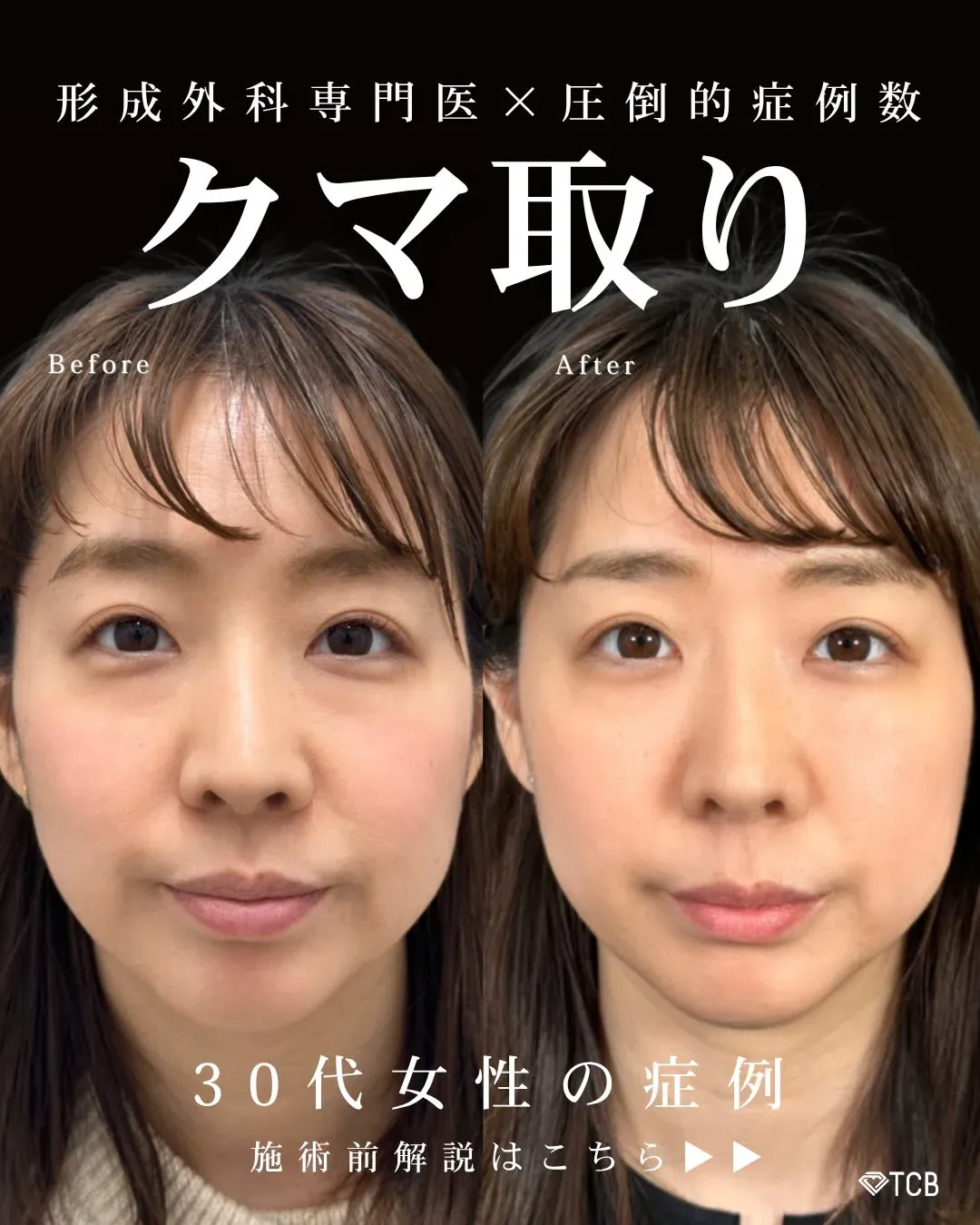 TCB佐野医師のクマ取り症例