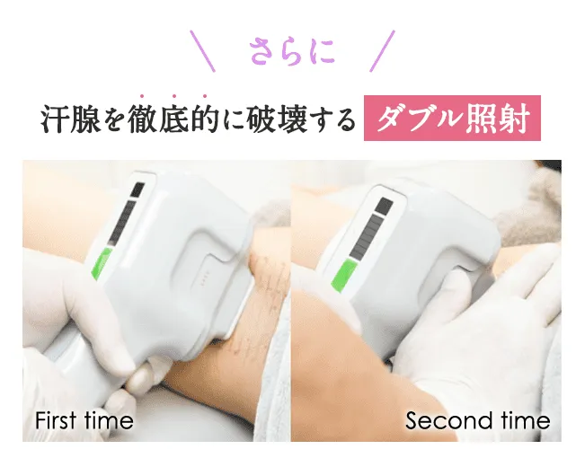 京都でミラドライが安いおすすめの共立美容外科のダブル照射説明