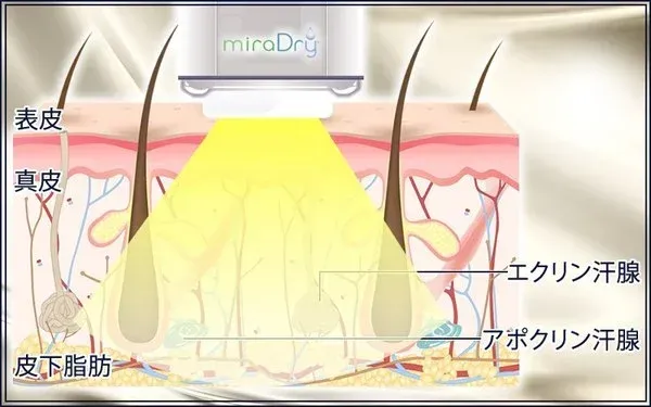 共立美容外科　ミラドライの仕組み