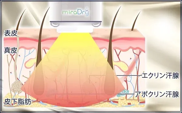 神戸でミラドライが安いおすすめのクリニック　湘南美容クリニックの仕組み