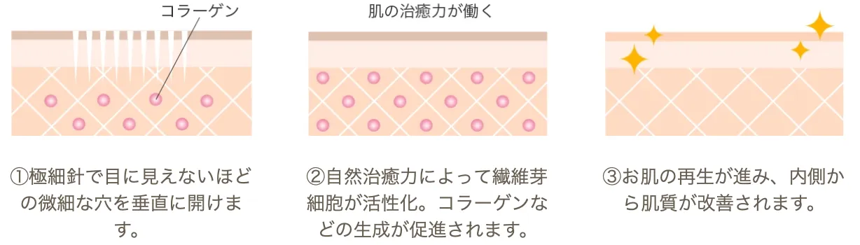 マリアクリニック ダーマペン 仕組み