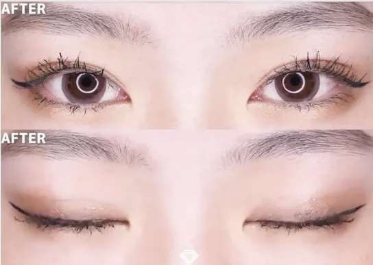 目黒区で二重整形がおすすめのクリニック　症例写真