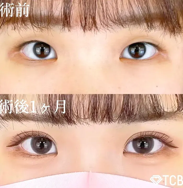 目黒区で二重整形がおすすめのクリニック　TCBのLP画像
