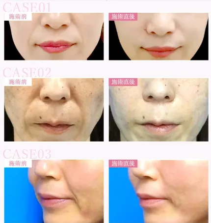 当記事がおすすめするTCBでヒアルロン酸注射を受けた方の症例写真