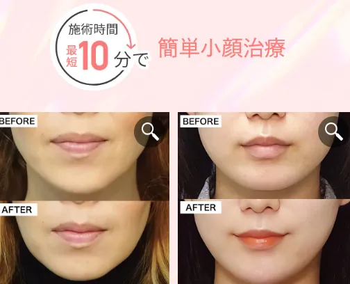 大阪にあるTCBのボトックスは最短約10分で完了する