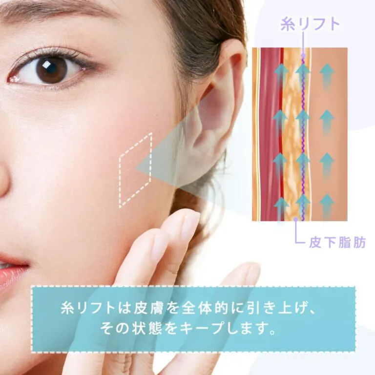 札幌で糸リフトが安いおすすめのクリニック　eクリニックのLP画像　引き上げ