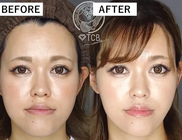 仙台でエラボトックスが上手い先生がいると口コミで評判のTCB　症例写真②