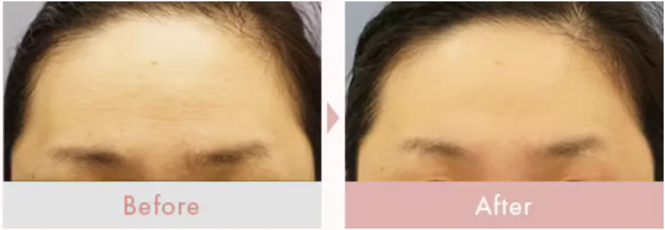 湘南美容クリニック イオン導入 ビフォーアフター