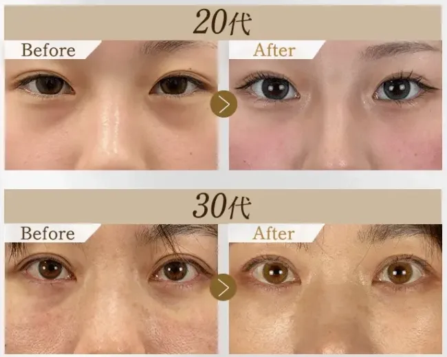 Tクリニック横浜院の口コミ評判|切らない黄金比クマ取りの症例写真