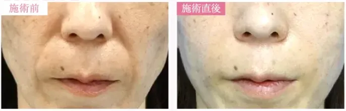 TCBのヒアルロン酸注射症例