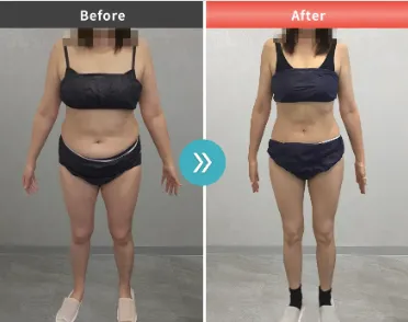 URARAクリニックの脂肪冷却の症例写真