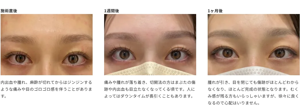 HAABクリニックの二重整形の経過写真