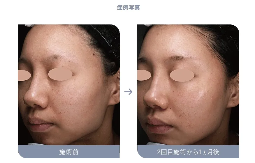 アクネスカーピコのダウンタイムの経過症例写真