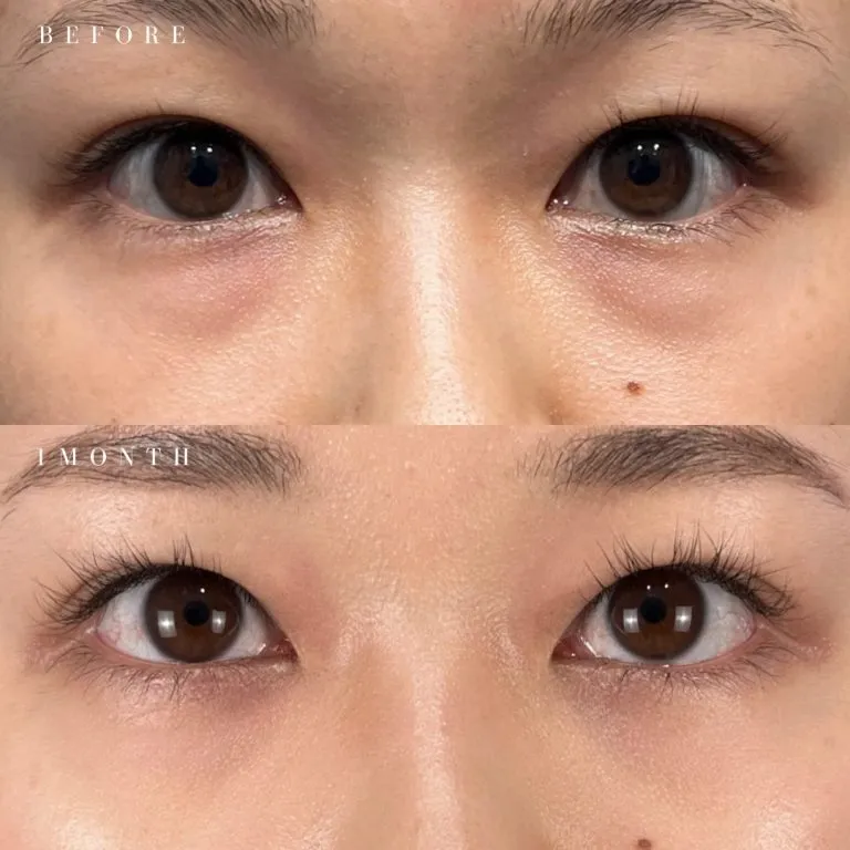 TCBのクマ取り9,800円の症例