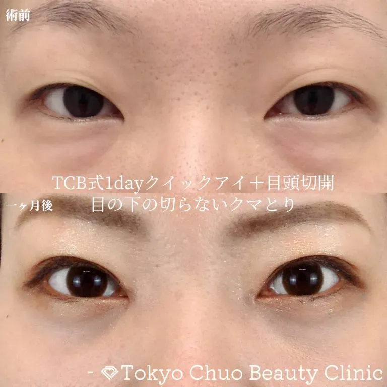 TCBの埋没の症例