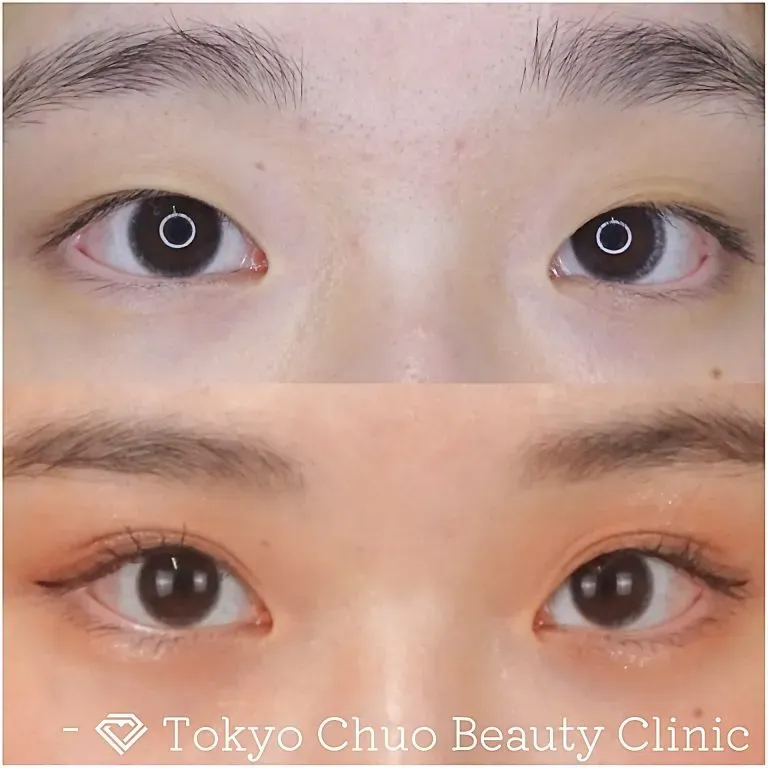 TCBの二重埋没の症例