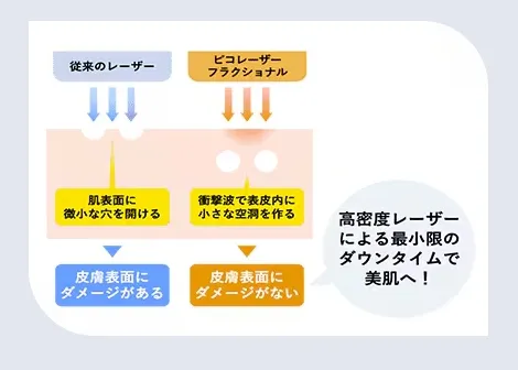 従来のレーザーとピコレーザーのダウンタイムの違いについて