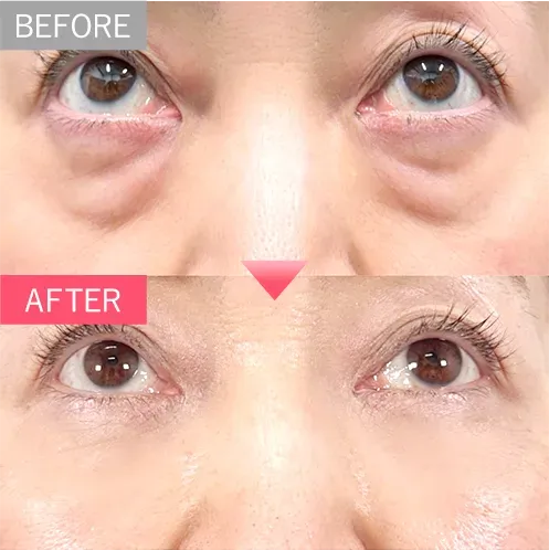 TCBのモニターは写真撮られる?行かなかったらどうなる?【知恵袋越え】クマ取り注射症例写真