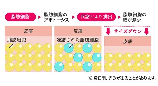 URARAクリニックの脂肪冷却のメカニズム