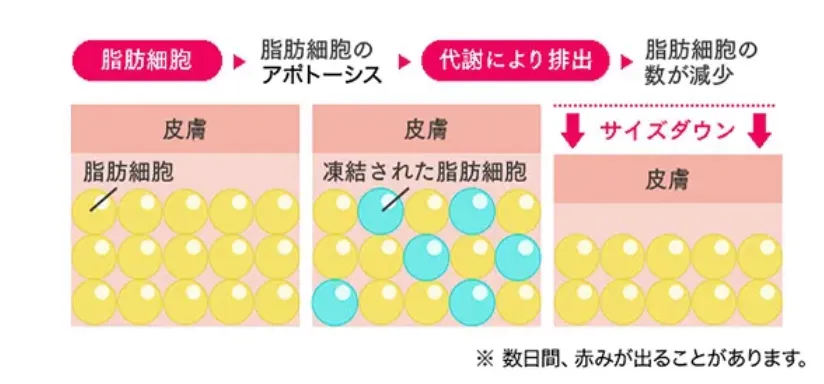 銀座で脂肪冷却が安いおすすめのクリニック　uraraクリニックの施術内容