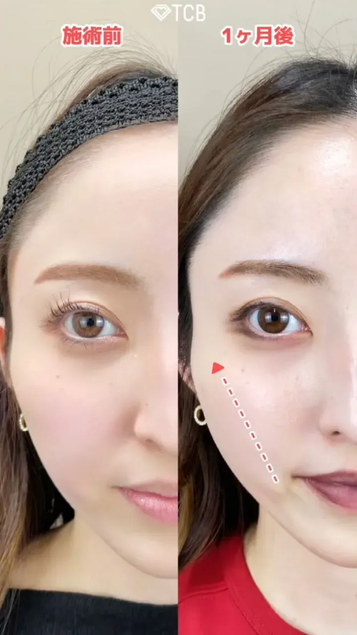  TCBの80,000円クーポン｜ TCBの糸リフトの症例写真