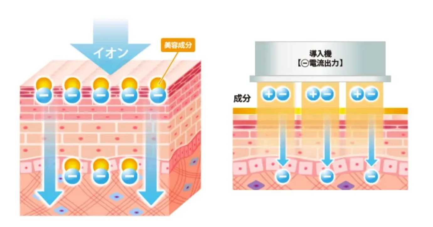 TCBのイオン導入の口コミ評判【料金や薬剤も調査！】｜ イオン導入の仕組み