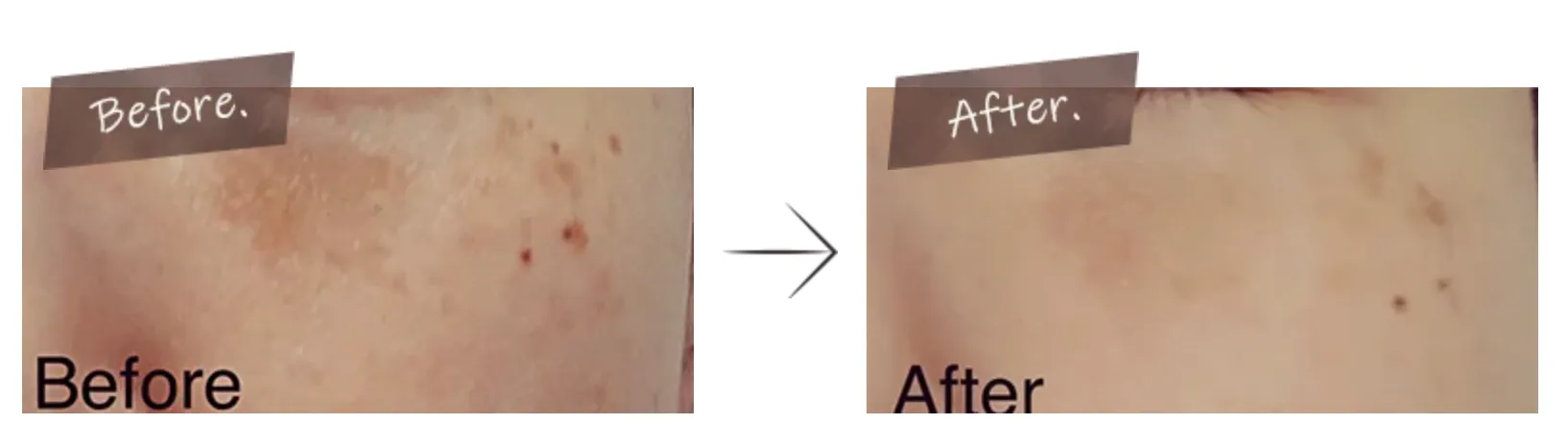 TCBのイオン導入の口コミ評判【料金や薬剤も調査！】｜  TCBのイオン導入の症例写真