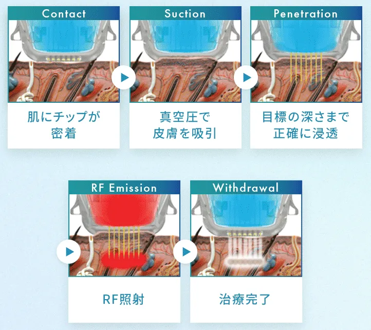 大阪でエリシスセンスが安いおすすめのクリニック｜エリシスセンスの真空サクション機能