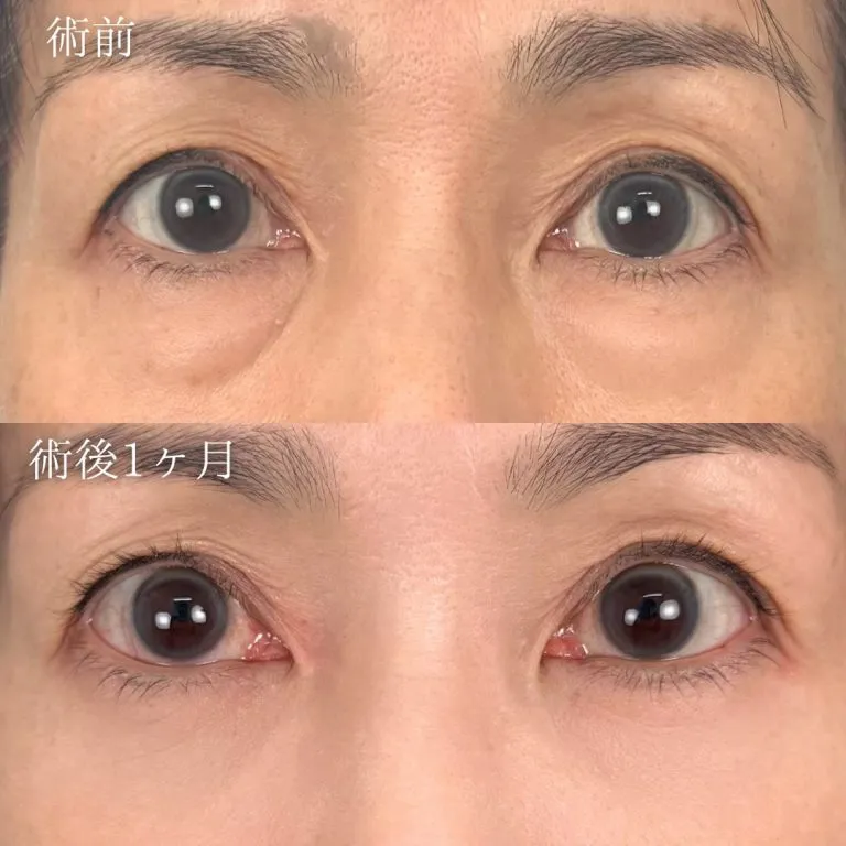 TCBのクマ取り9,800円の症例