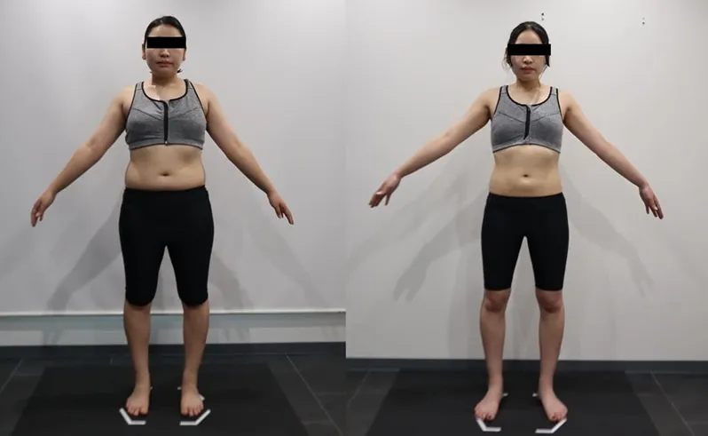 マニョ注射の効果は? ディオクリニックの症例写真