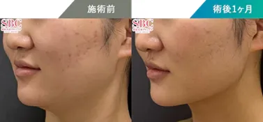 オンダリフトがキャンペーン価格で受けられるクリニック　湘南美容クリニックの症例写真①