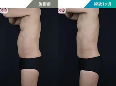 オンダリフトがキャンペーン価格で受けられるクリニック　湘南美容クリニックの症例写真②