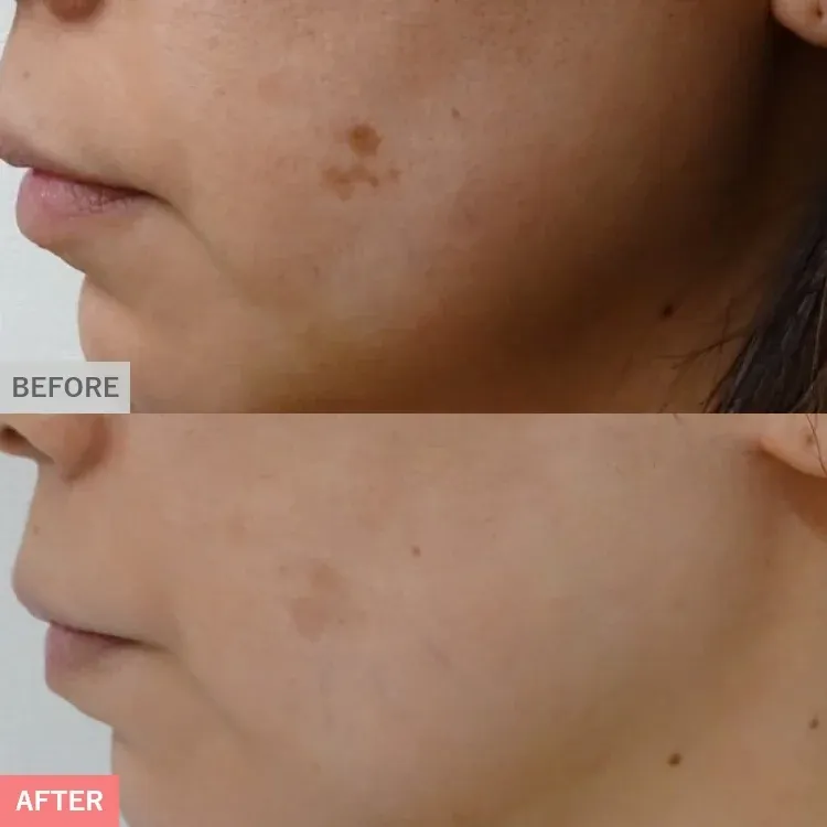 TCBのモニターは写真撮られる?行かなかったらどうなる?【知恵袋越え】シミ取り症例写真