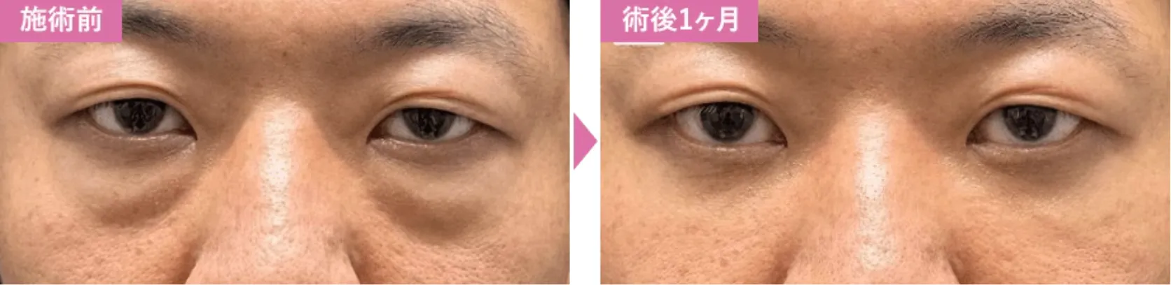 4月の月替わりキャンペーンを行なっているSBC湘南美容クリニックの症例写真