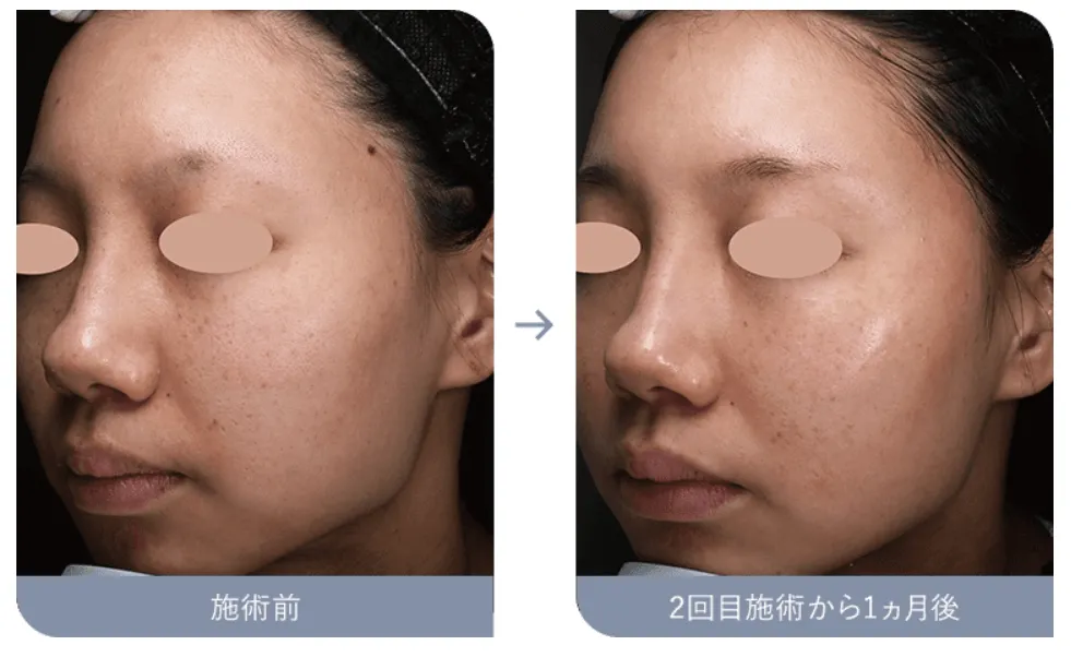 湘南美容クリニックのアクネスカーピコの症例写真