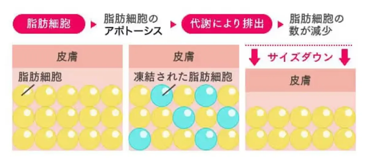 新宿で脂肪冷却が安いおすすめのクリニック【メンズ向けも】｜脂肪冷却装置の仕組み