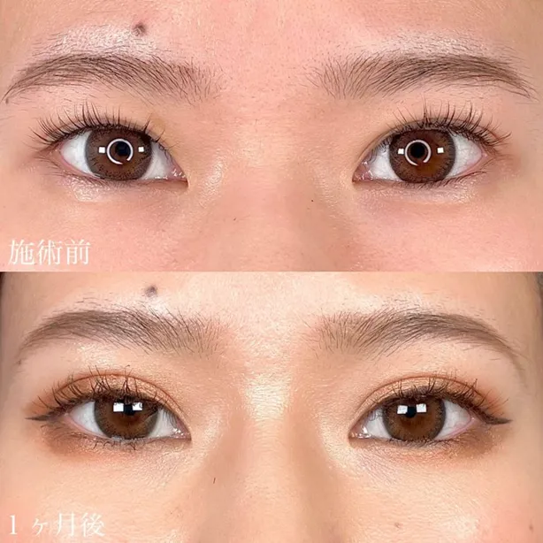 TCBの二重埋没の症例