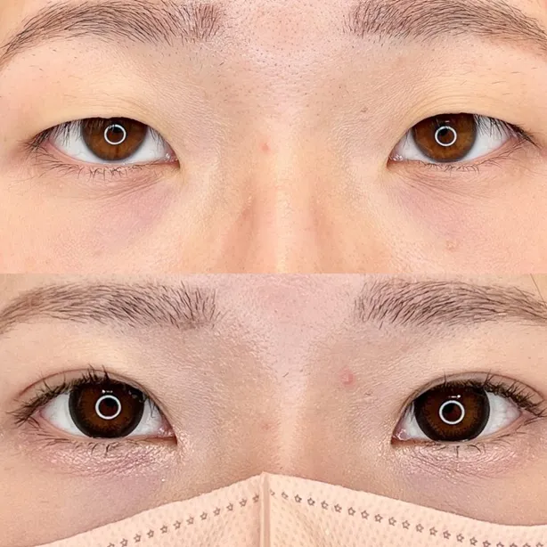 TCBの二重埋没の症例