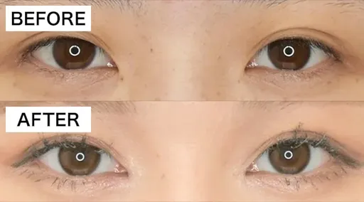 目尻切開の症例写真