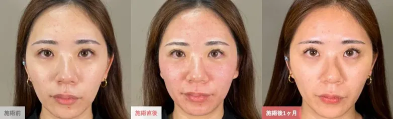 TCBのポテンツァの症例写真